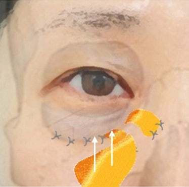 Penataan Ulang Lemak + Penguatan Septum + Pengangkatan Pipi Depan Sekaligus... 사진 5