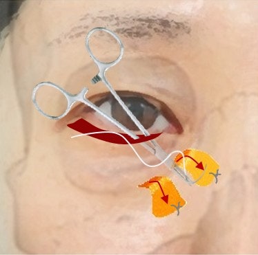 Penataan Ulang Lemak + Penguatan Septum + Pengangkatan Pipi Depan Sekaligus... 사진 3