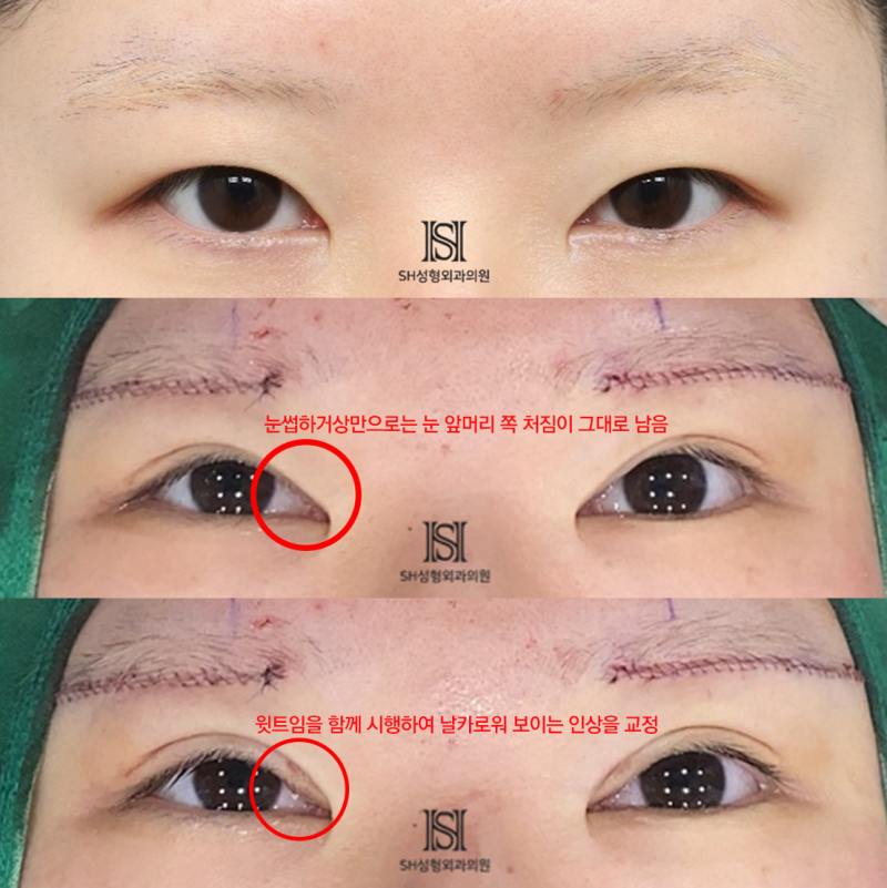 #1 Operasi Pengangkatan Alis Bawah, Mengapa Harus Disertai dengan Epicanthoplasty Atas? 사진 11
