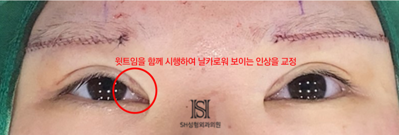 #1 Operasi Pengangkatan Alis Bawah, Mengapa Harus Disertai dengan Epicanthoplasty Atas? 사진 9