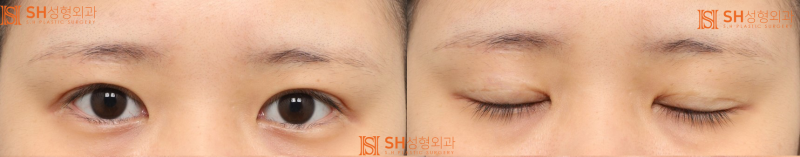#2 Correcting Asymmetrical Eyes with Sub-Brow Lift 사진 2