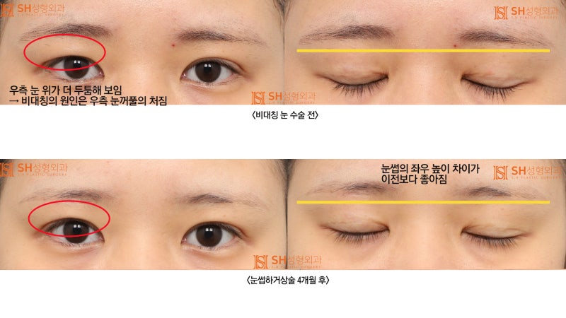 #2 Correcting Asymmetrical Eyes with Sub-Brow Lift