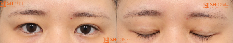 #2 Correcting Asymmetrical Eyes with Sub-Brow Lift