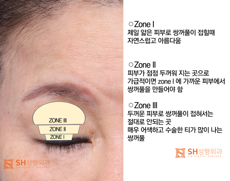 #4 Upper Blepharoplasty? Causes and Analysis of Upper Blepharoplasty Failure 사진 2