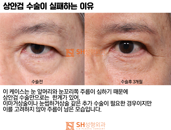 #4 Upper Blepharoplasty? Causes and Analysis of Upper Blepharoplasty Failure 사진 6