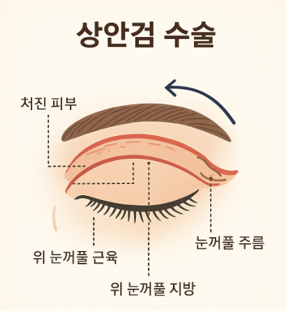 #4 Upper Blepharoplasty? Causes and Analysis of Upper Blepharoplasty Failure