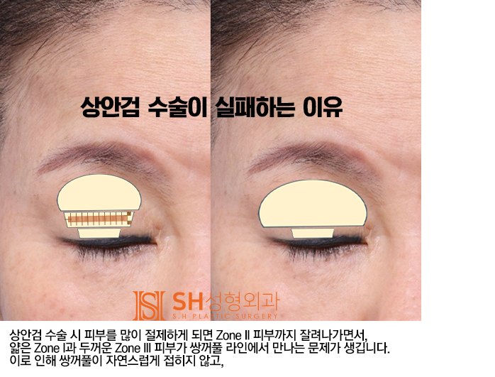 #4 Upper Blepharoplasty? Causes and Analysis of Upper Blepharoplasty Failure 사진 3