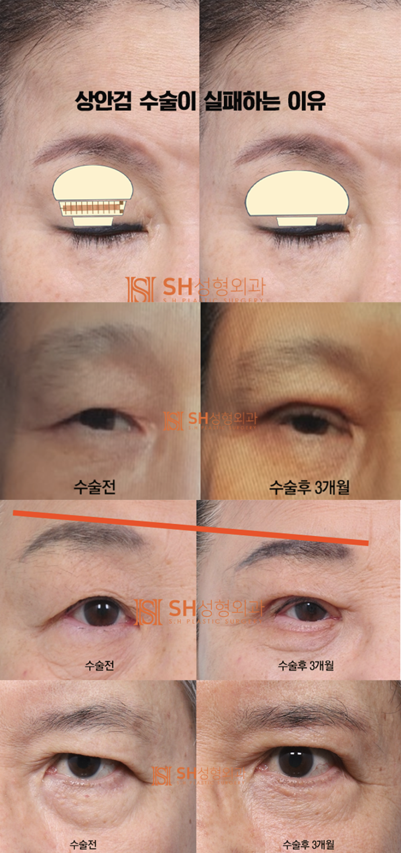 #4 Upper Blepharoplasty? Causes and Analysis of Upper Blepharoplasty Failure 사진 7