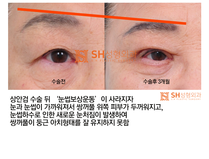 #4 Upper Blepharoplasty? Causes and Analysis of Upper Blepharoplasty Failure 사진 5