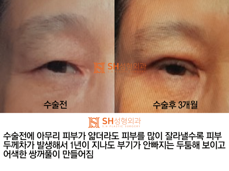 #4 Upper Blepharoplasty? Causes and Analysis of Upper Blepharoplasty Failure