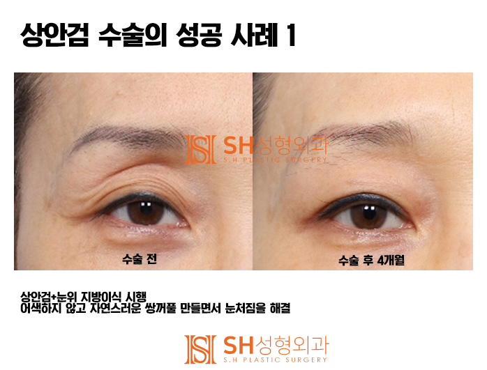 #5 Upper Blepharoplasty Success Story: 'It All Comes Down to the Details!'