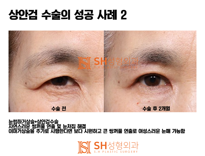 #5 Upper Blepharoplasty Success Story: 'It All Comes Down to the Details!' 사진 2