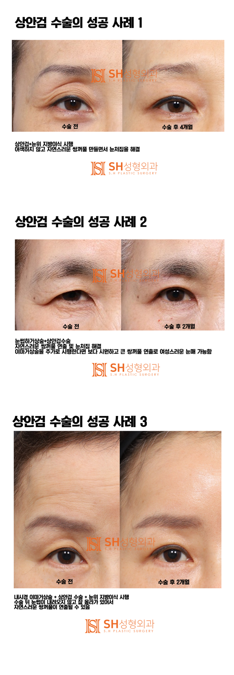 #5 Upper Blepharoplasty Success Story: 'It All Comes Down to the Details!' 사진 4