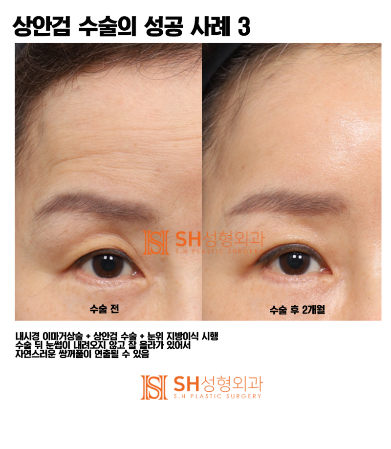 #5 Upper Blepharoplasty Success Story: 'It All Comes Down to the Details!' 사진 3