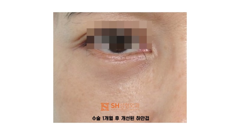 #6 눈밑 주름과 불룩함, 하안검 성형의 진실