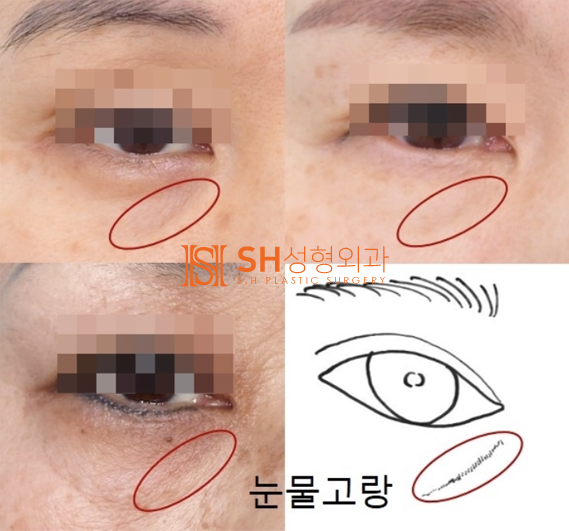 #6 눈밑 주름과 불룩함, 하안검 성형의 진실 사진 3