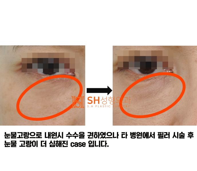 #6 눈밑 주름과 불룩함, 하안검 성형의 진실 사진 6