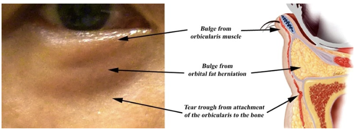 #7 Lower Blepharoplasty Choices – Fat Removal vs. Under-Eye Fat Repositioning: Differences and Limitations