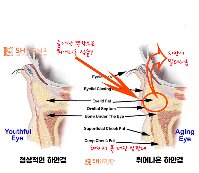 #7 Lower Blepharoplasty Choices – Fat Removal vs. Under-Eye Fat Repositioning: Differences and Limitations 사진 2