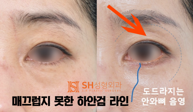 #7 Lower Blepharoplasty Choices – Fat Removal vs. Under-Eye Fat Repositioning: Differences and Limitations