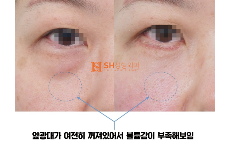 #7 Lower Blepharoplasty Choices – Fat Removal vs. Under-Eye Fat Repositioning: Differences and Limitations 사진 4