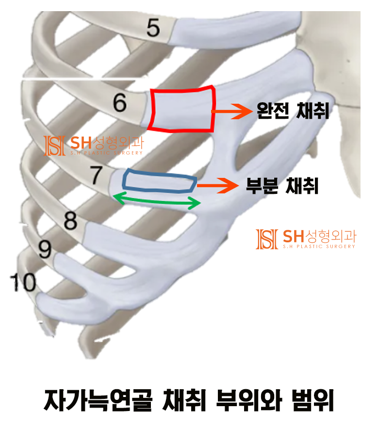 #11 Revision Rhinoplasty: Why Autologous Rib Cartilage? How to Avoid Side Effects _ Nose Surgery Materials 1/3 사진 3