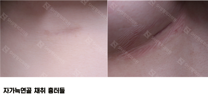 #11 Revision Rhinoplasty: Why Autologous Rib Cartilage? How to Avoid Side Effects _ Nose Surgery Materials 1/3