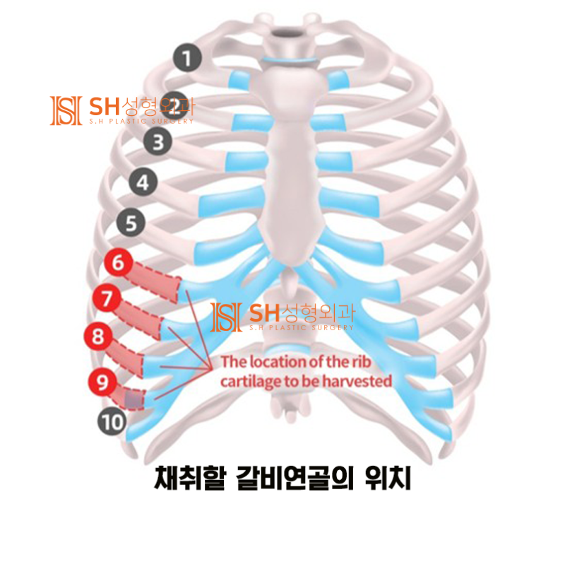 #11 Revision Rhinoplasty: Why Autologous Rib Cartilage? How to Avoid Side Effects _ Nose Surgery Materials 1/3 사진 2