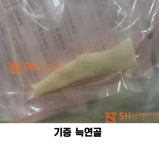 #12 기증늑연골 코재수술, 자가늑 채취부위 통증이 걱정이라면 _ 코수술 재료에 대하여 2/3