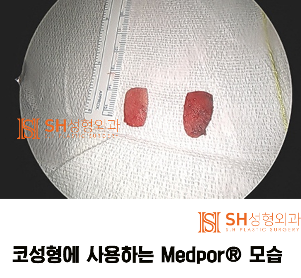 #13 Artificial Materials as a Cause of Nose Surgery Side Effects: Revision Rhinoplasty_About Nose Surgery Materials 3/3