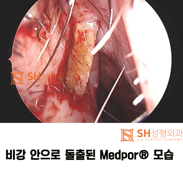 #13 Artificial Materials as a Cause of Nose Surgery Side Effects: Revision Rhinoplasty_About Nose Surgery Materials 3/3