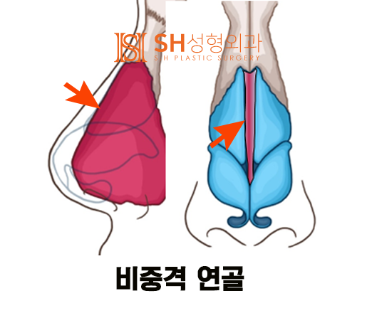 #14 Rhinoplasty, Tip Plasty Materials: Understanding Nasal Structure First 사진 3