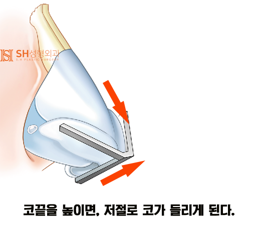 #14 Rhinoplasty, Tip Plasty Materials: Understanding Nasal Structure First 사진 5