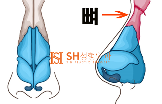 #14 Rhinoplasty, Tip Plasty Materials: Understanding Nasal Structure First