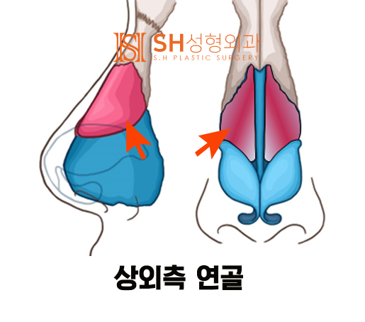 #14 Rhinoplasty, Tip Plasty Materials: Understanding Nasal Structure First 사진 2