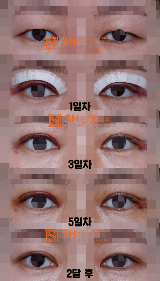 #16 Double Eyelid Surgery Swelling: How Long Does It Last and How to Manage It?