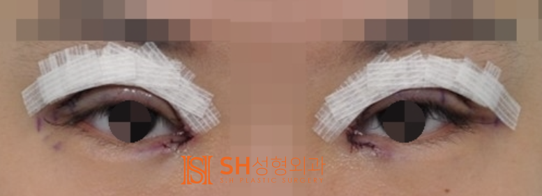 #16 Double Eyelid Surgery Swelling: How Long Does It Last and How to Manage It? 사진 4