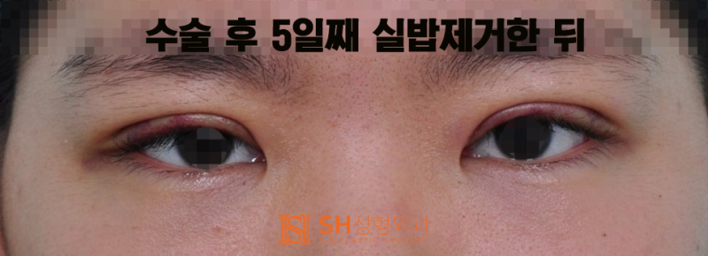 #17 How to Correct Asymmetrical Eyes Without Ptosis Correction — Symmetrical Design by Facial Designer Dr. Kim Sung-hoon