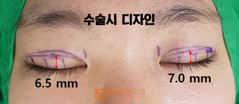 #17 How to Correct Asymmetrical Eyes Without Ptosis Correction — Symmetrical Design by Facial Designer Dr. Kim Sung-hoon