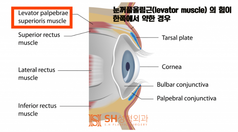 #17 How to Correct Asymmetrical Eyes Without Ptosis Correction — Symmetrical Design by Facial Designer Dr. Kim Sung-hoon