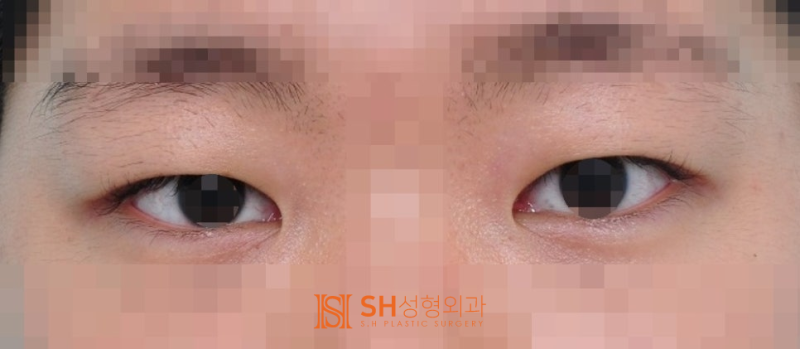 #17 How to Correct Asymmetrical Eyes Without Ptosis Correction — Symmetrical Design by Facial Designer Dr. Kim Sung-hoon