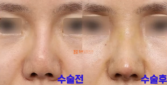 #18 Nose Revision Surgery Review: How Much Can It Change? 사진 3