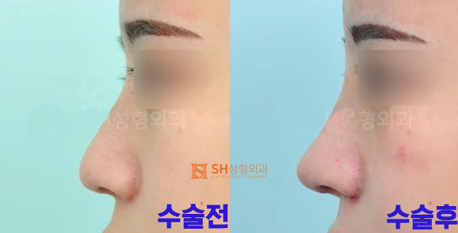 #18 Nose Revision Surgery Review: How Much Can It Change?