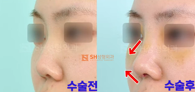 #18 Nose Revision Surgery Review: How Much Can It Change?