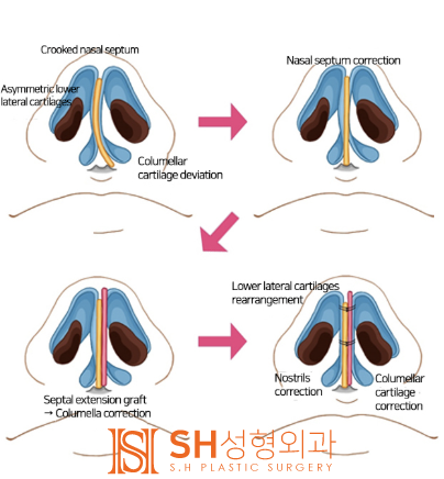 #19 Revision Rhinoplasty Side Effects and Cases: When is it Possible and How Can it Change? 사진 2