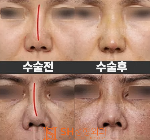 #19 Revision Rhinoplasty Side Effects and Cases: When is it Possible and How Can it Change? 사진 6
