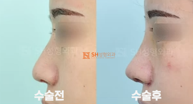 #19 Revision Rhinoplasty Side Effects and Cases: When is it Possible and How Can it Change?