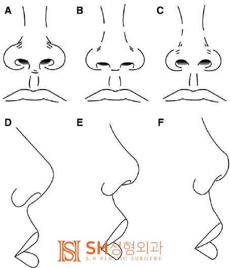 #19 Revision Rhinoplasty Side Effects and Cases: When is it Possible and How Can it Change?