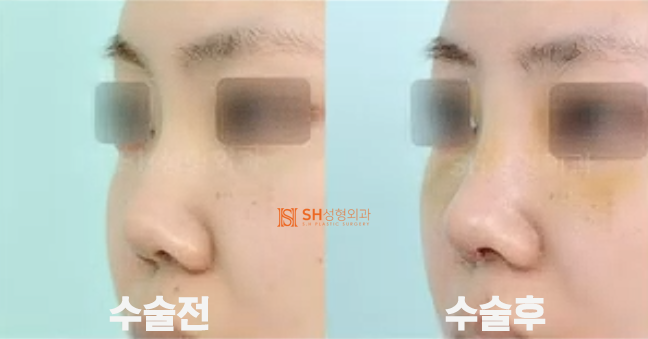 #19 Revision Rhinoplasty Side Effects and Cases: When is it Possible and How Can it Change? 사진 4