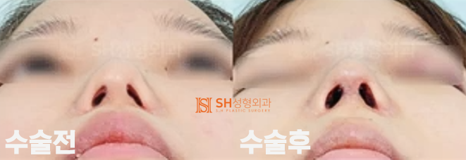 #19 Revision Rhinoplasty Side Effects and Cases: When is it Possible and How Can it Change? 사진 5